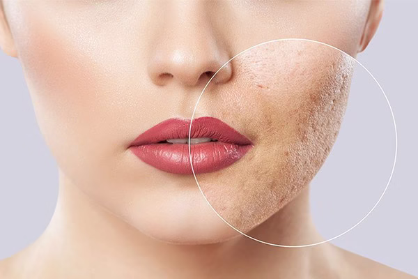 علت ایجاد منافذ باز پوست چیست؟