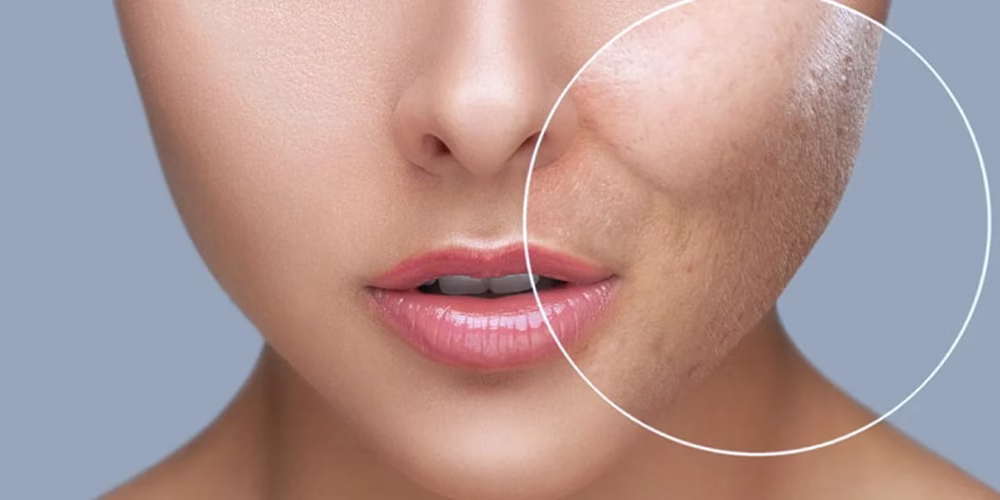 علت ایجاد منافذ باز پوست چیست؟